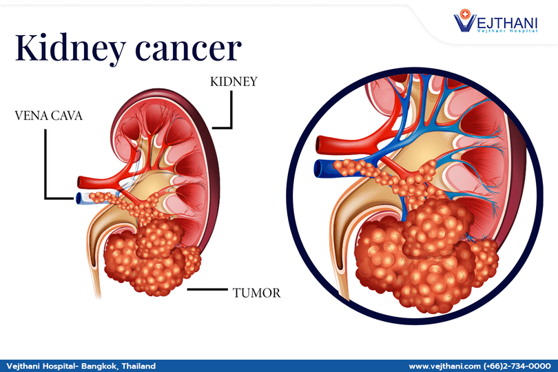 Time is of the Essence: Early Treatment Increases Chance of Permanent Cure for Kidney Cancer