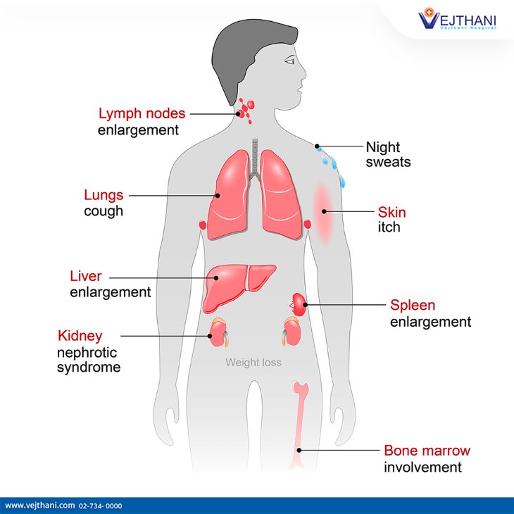 Vejthani Hospital Provides Lymphoma Treatment in Thailand