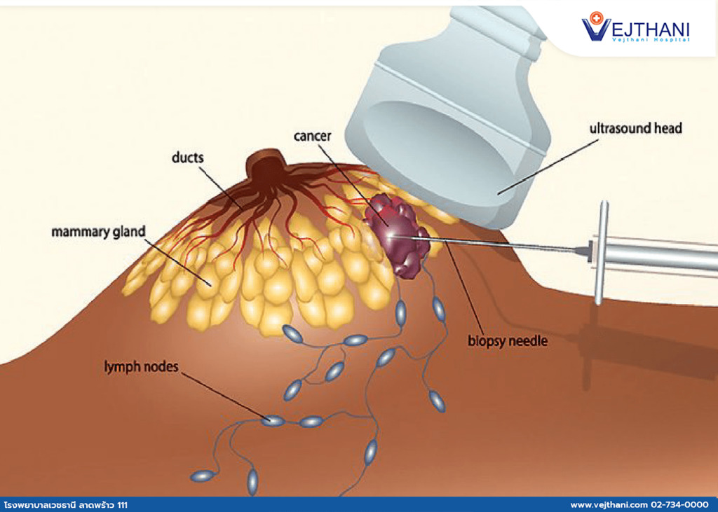 Breast Lump Biopsy: Addressing Anxiety and Uncertainty with Prompt Diagnosis